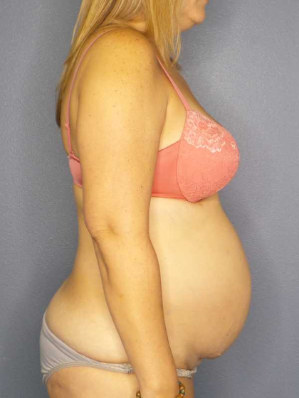 High BMI (Larger Patients) Surgery Before & After Patient #10329