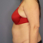Liposuction Female Before & After Patient #7932