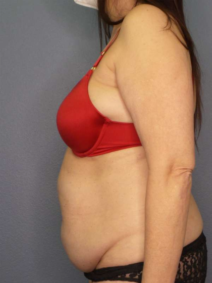 Liposuction Female Before & After Patient #7932