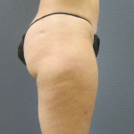 Liposuction Female Before & After Patient #7794