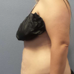 Abdominoplasty Before & After Patient #5197