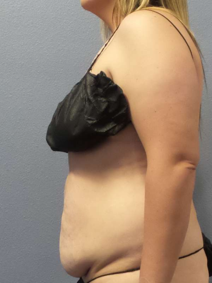 Abdominoplasty Before & After Patient #5197