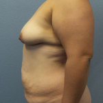 Abdominoplasty Before & After Patient #3735