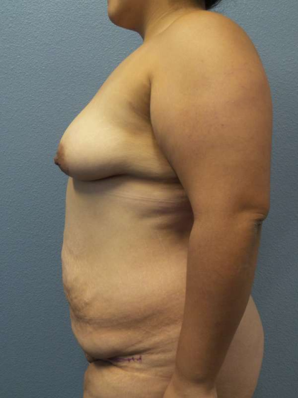 Abdominoplasty Before & After Patient #3735