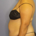 Abdominoplasty Before & After Patient #3638