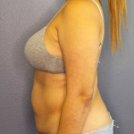 Abdominoplasty Before & After Patient #3583