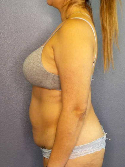 Abdominoplasty Before & After Patient #3583