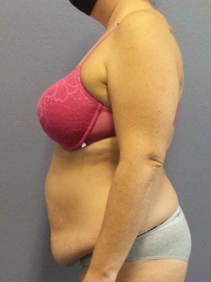 Abdominoplasty Before & After Patient #3572