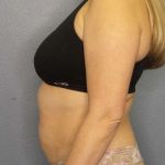 Liposuction Female Before & After Patient #7966