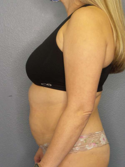 Liposuction Female Before & After Patient #7966