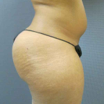 Brazilian Butt Lift Before & After Patient #4903