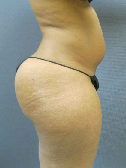 Brazilian Butt Lift Before & After Patient #4903
