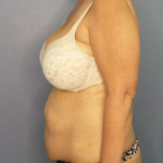 Abdominoplasty Before & After Patient #3786