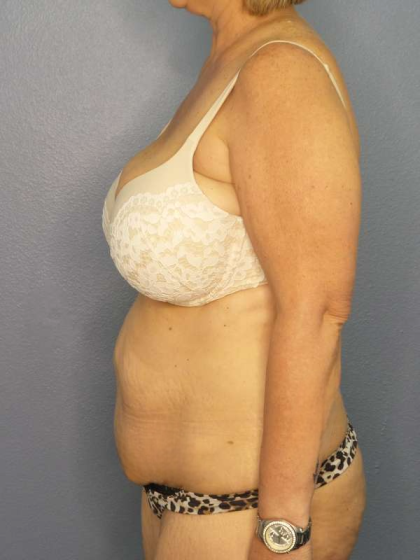 Abdominoplasty Before & After Patient #3786