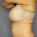 Liposuction Female Before & After Patient #8123