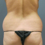 Liposuction Female Before & After Patient #7776