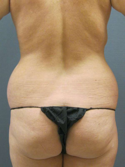 Liposuction Female Before & After Patient #7776