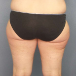 Liposuction Female Before & After Patient #7709