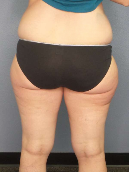 Liposuction Female Before & After Patient #7709