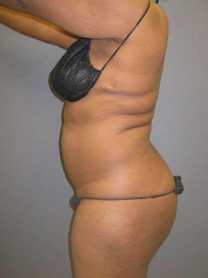 Liposuction Female Before & After Patient #7668