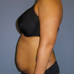Abdominoplasty Before & After Patient #3775