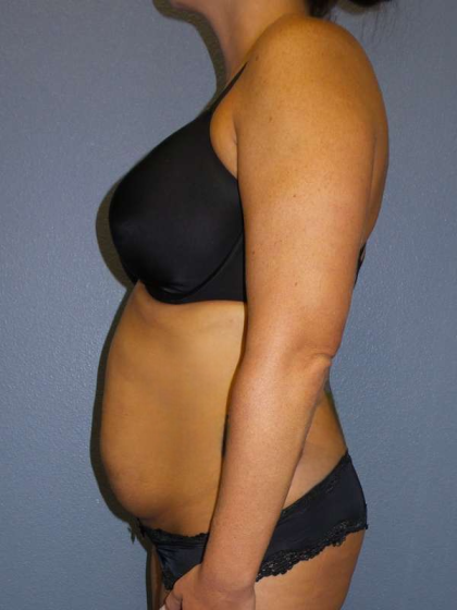Abdominoplasty Before & After Patient #3775