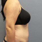 Abdominoplasty Before & After Patient #3550