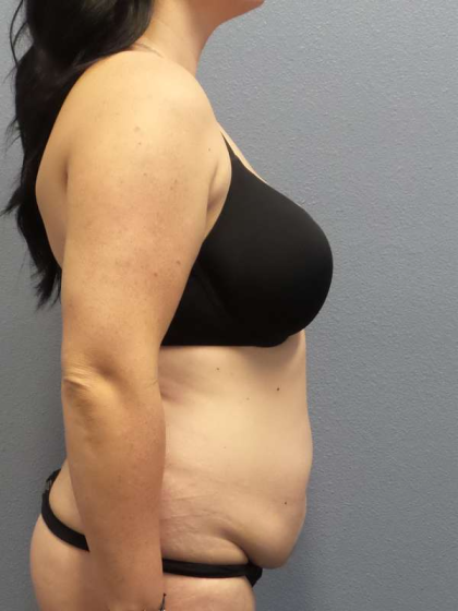Abdominoplasty Before & After Patient #3550