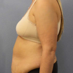 Abdominoplasty Before & After Patient #3594
