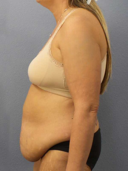 Abdominoplasty Before & After Patient #3594