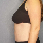 Abdominoplasty Before & After Patient #3409