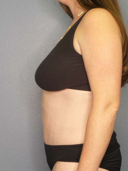 Abdominoplasty Before & After Patient #3409