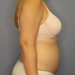 Abdominoplasty Before & After Patient #3350