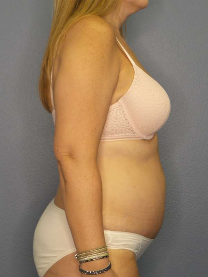 Abdominoplasty Before & After Patient #3350