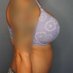 Abdominoplasty Before & After Patient #3272