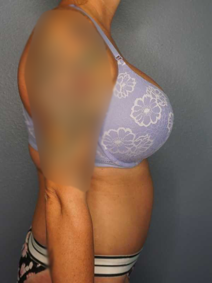Abdominoplasty Before & After Patient #3272