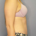 Abdominoplasty Before & After Patient #3236