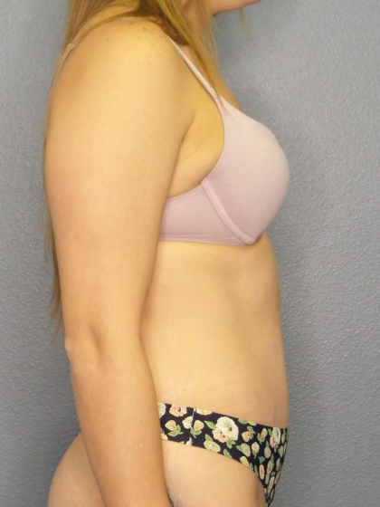 Abdominoplasty Before & After Patient #3236