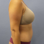 Abdominoplasty Before & After Patient #3225