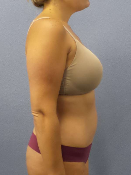 Abdominoplasty Before & After Patient #3225