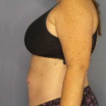 Liposuction Female Before & After Patient #11950