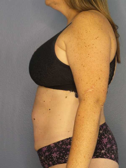 Liposuction Female Before & After Patient #11950