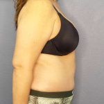 Abdominoplasty Before & After Patient #3188