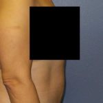 Abdominoplasty Before & After Patient #11131