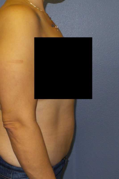 Abdominoplasty Before & After Patient #11131
