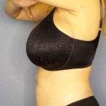 Liposuction Female Before & After Patient #8123