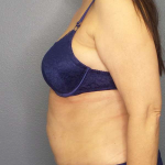 Liposuction Female Before & After Patient #7932