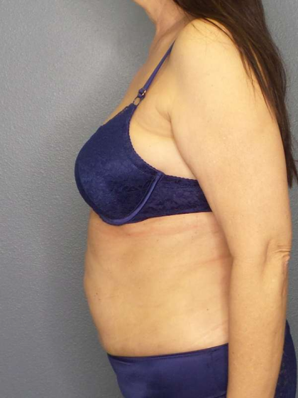 Liposuction Female Before & After Patient #7932