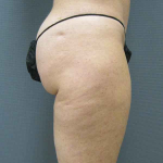 Liposuction Female Before & After Patient #7794