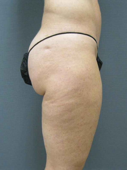 Liposuction Female Before & After Patient #7794